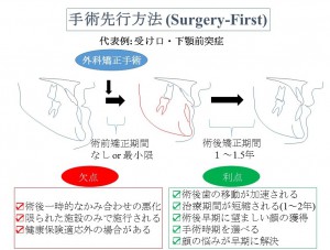 顎変形症の外科手術先行方法　サージャリーファーストアプローチ