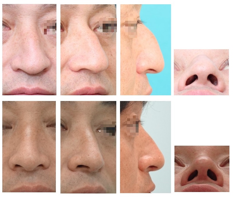 鼻整形・形成術（鼻の曲がり/斜鼻/鼻中隔弯曲症、鞍鼻の治療 