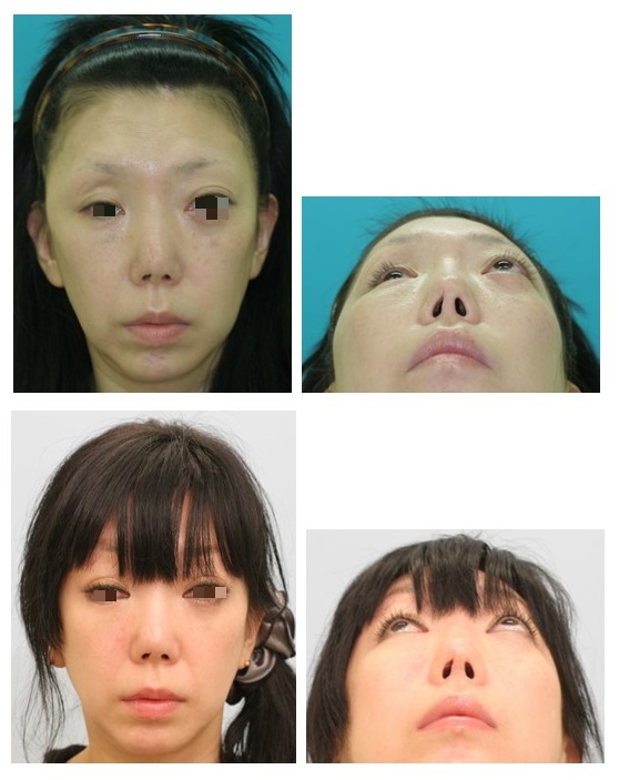代表的な症例 受け口などの顎変形症 あごえら 小顔矯正 性同一性障害の顔面輪郭 鼻整形 顔面変形 睡眠時無呼吸症候群の形成美容外科専門治療 東京警察病院 形成外科 美容外科
