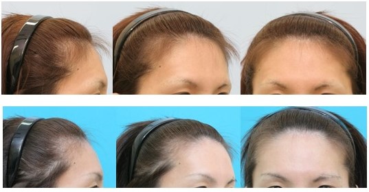 前頭洞縮小を伴う前額部形成術＋眼窩上縁骨削り＋人工骨ペーストによる前額形成術　女性化手術