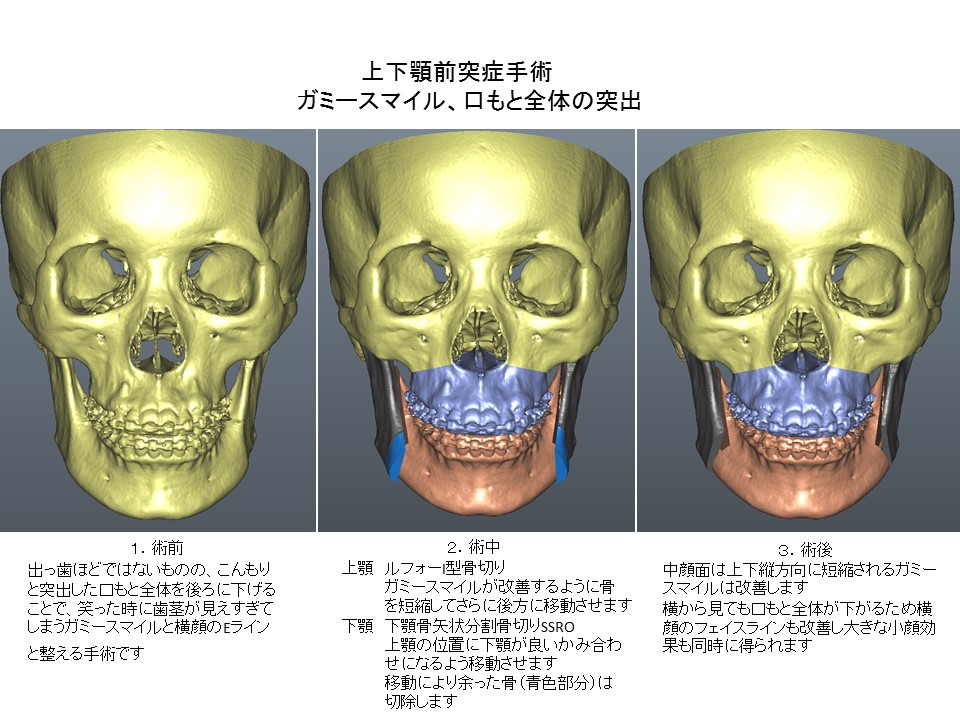 口もと全体が出ている・上下顎前突症・ガミースマイルの上下顎骨切り術１