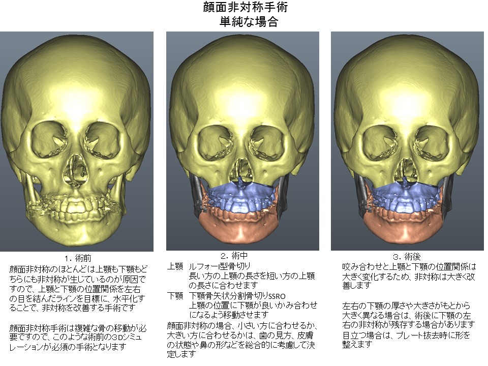 顔面非対称手術　ルフォーI型骨切り術＋下顎骨矢状分割骨切り術１
