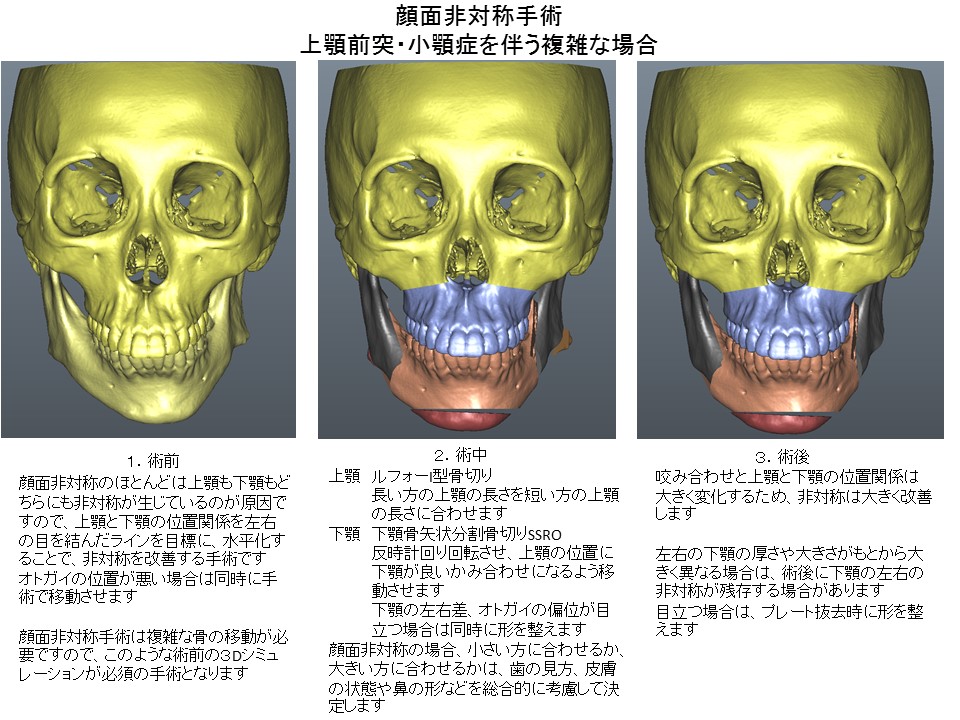 顔面非対称手術　ルフォーI型骨切り術＋下顎骨矢状分割骨切り術＋オトガイ形成術１