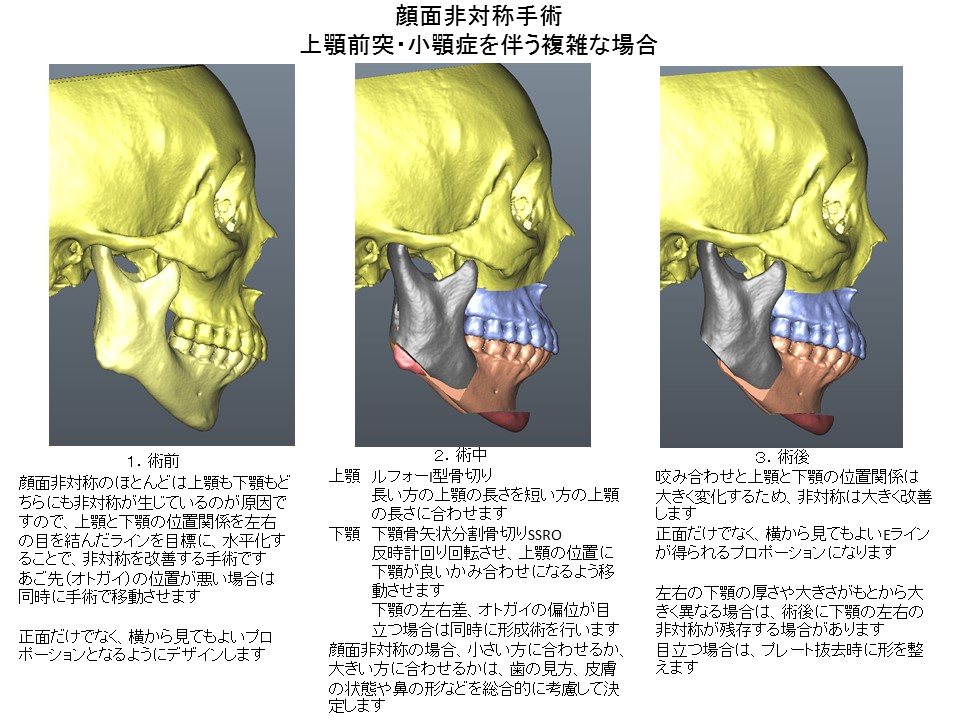 顔面非対称手術　ルフォーI型骨切り術＋下顎骨矢状分割骨切り術＋オトガイ形成術２