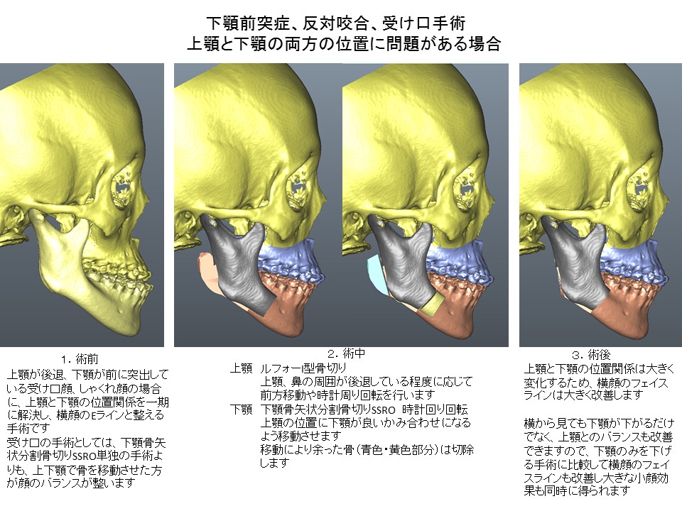 下顎前突症、反対咬合、受け口、しゃくれ手術： 上顎と下顎の両方の位置に問題がある場合